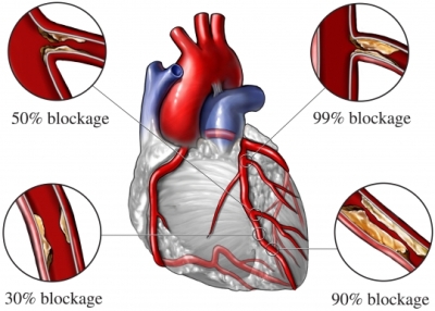 Math models enhance current therapies for coronary hEart disease